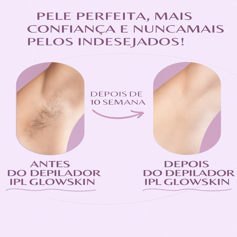 Depilador Corporal em Laser IPL GlowSkin I Pele Lisa em Minutos